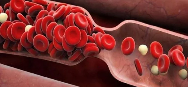 Phương pháp Tiêu sợi huyết trong điều trị đột quỵ nhồi máu não
